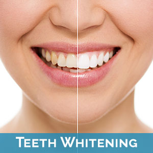 Teeth Whitening in West Des Moines