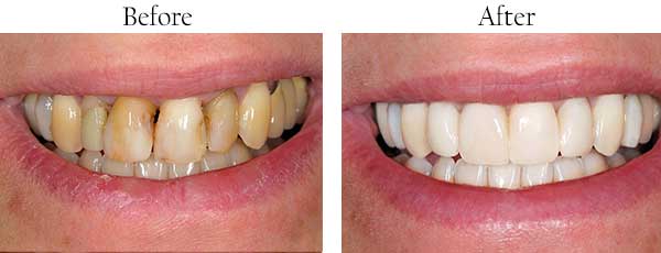 Before and After Teeth Whitening in West Des Moines