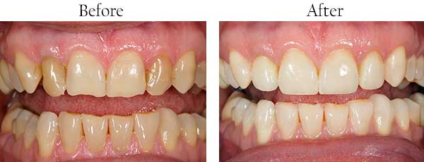 Before and After Invisalign in West Des Moines
