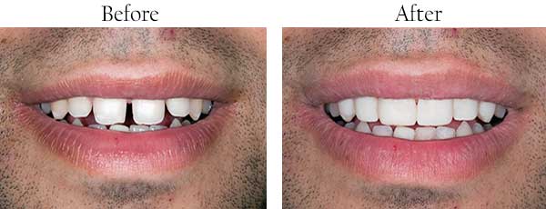 Before and After Dental Implants in West Des Moines