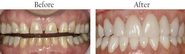Before and After Veneers in West Des Moines