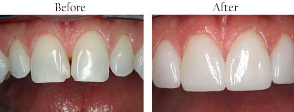 Before and After Dental Crowns in West Des Moines