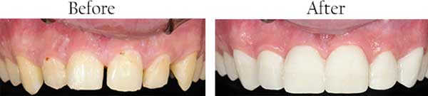 West Des Moines Before and After Invisalign