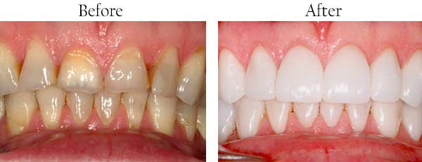 West Des Moines Before and After Dental Implants