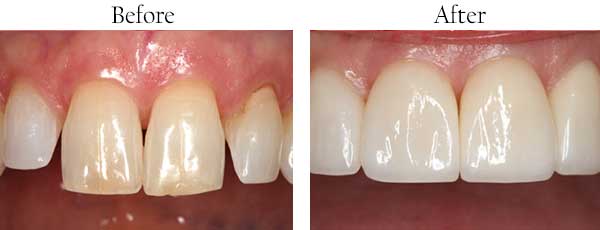 West Des Moines Before and After Teeth Whitening